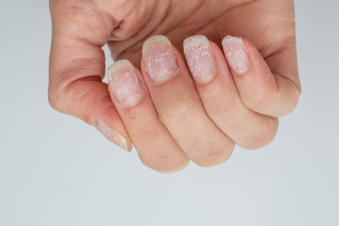damaged nails